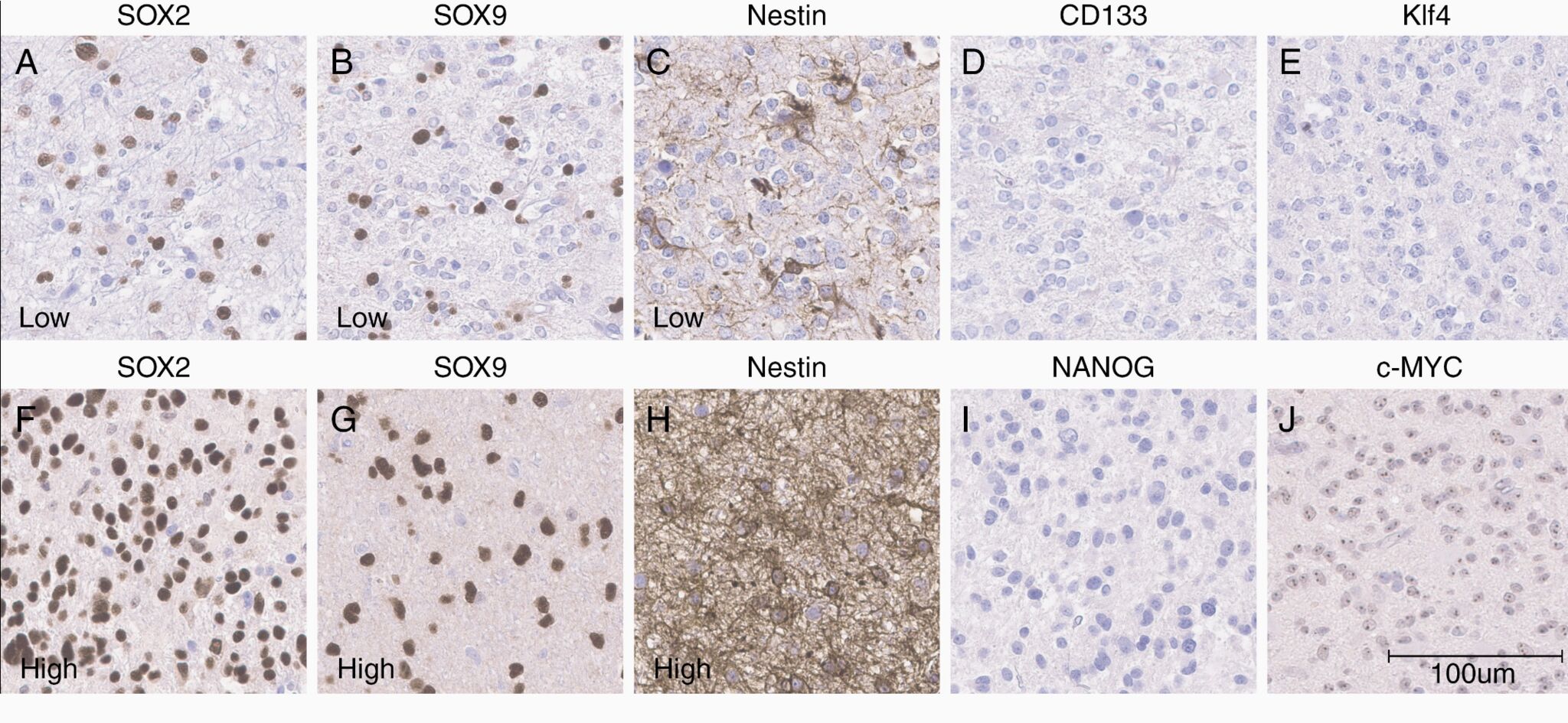 Four of our antibodies in glioma research