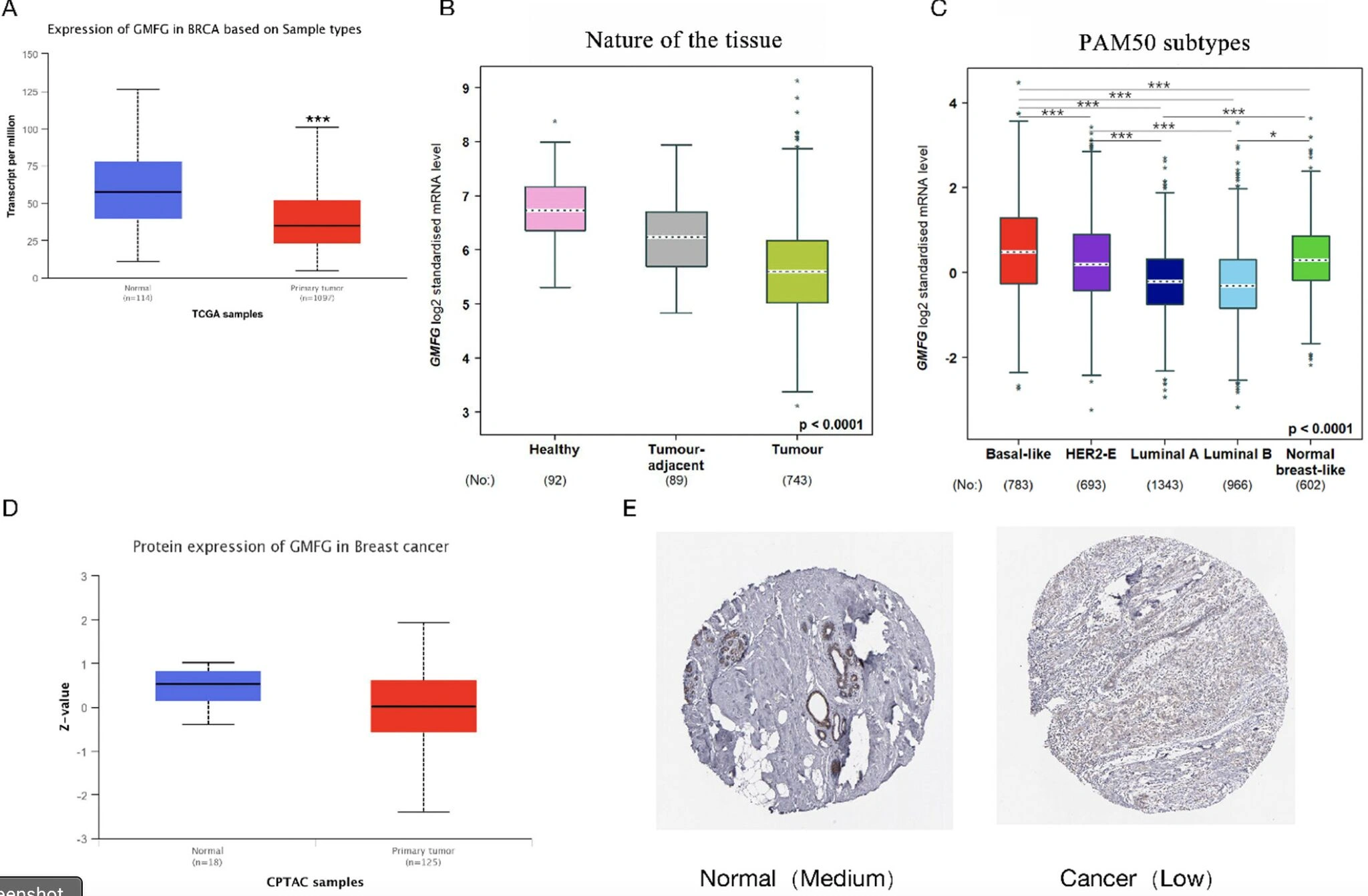 Gmfg Script GMFG Expression in Breast Cancer Using Anti‑GMFB Antibody
