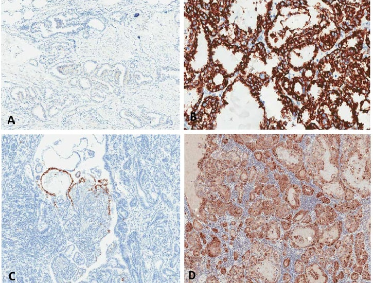 Our top 10 best-seller Anti-HNF1B monoclonal antibody used to stain human cancer tissue