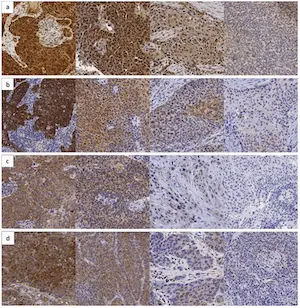 4 Triple A Polyclonals to understand oropharyngeal squamous cell carcinoma
