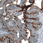 Immunohistochemical staining of human colorectal cancer shows strong membranous positivity.