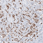 Immunohistochemical staining of human breast cancer shows moderate to strong nuclear positivity in tumor cells.
