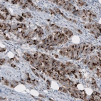 Immunohistochemical staining of human breast cancer shows strong cytoplasmic positivity.