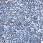 Immunohistochemical staining of human lung tumor (small cell lung cancer) shows no positivity in tumor cells as expected.