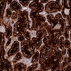 Immunohistochemical staining of human thyroid cancer shows strong cytoplasmic positivity in tumor cells.