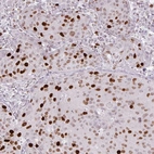 Immunohistochemical staining of human breast cancer shows moderate to strong nuclear positivity in tumor cells.