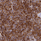 Immunohistochemical staining of human malignant melanoma shows moderate to strong cytoplasmic positivity in tumor cells.