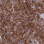Immunohistochemical staining of human malignant melanoma shows moderate to strong cytoplasmic positivity in tumor cells.