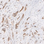 Immunohistochemical staining of human breast cancer shows moderate cytoplasmic positivity in tumor cells.