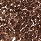 Immunohistochemical staining of human liver cancer shows strong cytoplasmic positivity in tumor cells.