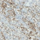 Immunohistochemical staining of human renal cancer shows membranous positivity in tumor cells.