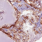 Immunohistochemical staining of human kidney (renal cancer) shows moderate immunoreactivity in cancer cells.