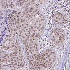 Immunohistochemical staining of human breast cancer shows moderate nuclear positivity in tumor cells.
