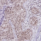 Immunohistochemical staining of human breast cancer shows moderate nuclear positivity in tumor cells.