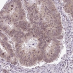 Immunohistochemical staining of human colorectal cancer shows weak to moderate nuclear positivity in a subset of tumor cells.