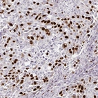 Immunohistochemical staining of human lung cancer shows moderate to strong nuclear positivity in a subset of tumor cells.