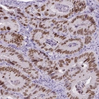 Immunohistochemical staining of human colorectal cancer shows moderate to strong nuclear positivity in tumor cells.