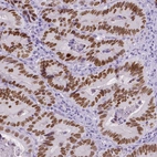 Immunohistochemical staining of human colorectal cancer shows strong nuclear positivity in tumor cells.