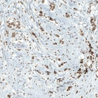 Immunohistochemical staining of human breast cancer shows moderate to strong nuclear positivity in tumor cells.