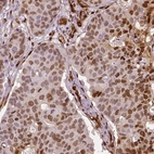 Immunohistochemical staining of human breast cancer shows moderate to strong nuclear positivity in tumor cells.