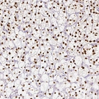 Immunohistochemical staining of human renal cancer shows strong nuclear positivity in tumor cells.