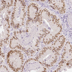 Immunohistochemical staining of human colorectal cancer shows moderate nuclear positivity in tumor cells.