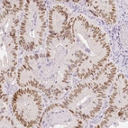 Immunohistochemical staining of human colorectal cancer shows moderate nuclear positivity in tumor cells.