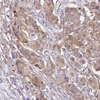 Immunohistochemical staining of human colorectal cancer shows moderate cytoplasmic positivity in tumor cells.