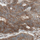 Immunohistochemical staining of human colorectal cancer (adenocarcinoma) shows cytoplasmic positivity in cancer cells.