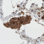 Immunohistochemical staining of human lung cancer (adenocacrinoma) shows strong cytoplasmic positivity in cancer cells.