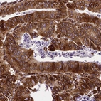 Immunohistochemical staining of human colorectal cancer shows strong cytoplasmic positivity in tumor cells.
