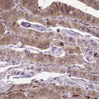 Immunohistochemical staining of human colorectal cancer shows moderate cytoplasmic positivity in tumor cells.