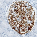 Immunohistochemical staining of human kidney (idiopathic membranous nephropathy) shows strong membranous positivity in cells in glomeruli.