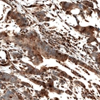 Immunohistochemical staining of human stomach cancer shows moderate to strong nuclear and cytoplasmic positivity in a subset of tumor cells.