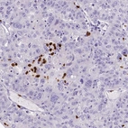 Immunohistochemical staining of human stomach cancer shows strong cytoplasmic positivity in lymphoid cells.