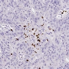 Immunohistochemical staining of human stomach cancer shows strong cytoplasmic positivity in lymphoid cells.
