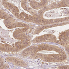 Immunohistochemical staining of human colorectal cancer shows moderate cytoplasmic positivity in tumor cells.