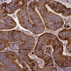 Immunohistochemical staining of human colorectal cancer shows strong cytoplasmic positivity in tumor cells.