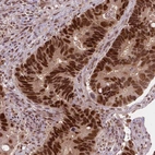 Immunohistochemical staining of human colorectal cancer shows strong nuclear positivity in tumor cells.