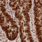 Immunohistochemical staining of human colorectal cancer shows strong nuclear positivity in tumor cells.