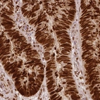 Immunohistochemical staining of human colorectal cancer shows strong nuclear positivity in tumor cells.