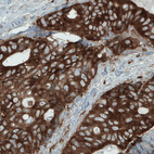 Immunohistochemical staining of human colorectal cancer shows strong cytoplasmic immunoreactivity in tumor cells.