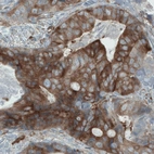 Immunohistochemical staining of human colorectal cancer shows strong cytoplasmic immunoreactivity in tumor cells.