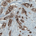 Immunohistochemical staining of human breast cancer shows strong positivity in tumor cells.