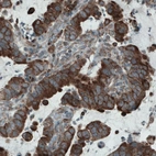 Immunohistochemical staining of stomach cancer shows cytoplasmic immunoreactivity in tumor cells.