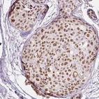 Immunohistochemical staining of human breast cancer shows moderate nuclear positivity in tumor cells.