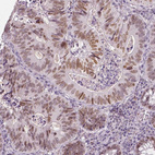 Immunohistochemical staining of human colorectal cancer shows moderate nuclear positivity in tumor cells.