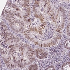 Immunohistochemical staining of human colorectal cancer shows moderate nuclear positivity in tumor cells.