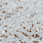 Immunohistochemical staining of human breast cancer shows moderate to strong nuclear positivity in a subset of tumor cells.