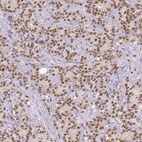 Immunohistochemical staining of human prostate cancer shows moderate nuclear positivity in tumor cells.